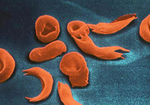 A doença falciforme é hereditária, é o resultado de uma modificação genética no gene (DNA). (Foto: Imagem Ilustrativa)